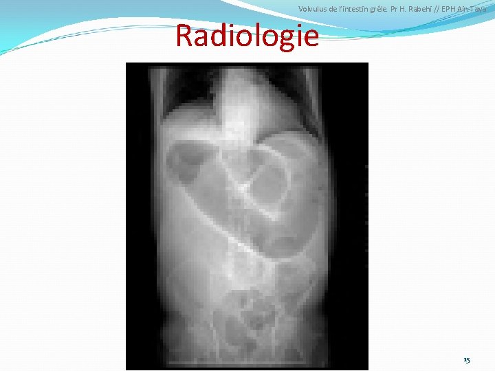Volvulus de l’intestin grêle. Pr H. Rabehi // EPH Ain-Taya Radiologie 15 