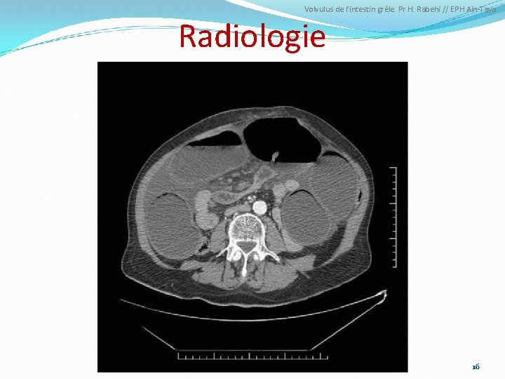 Volvulus de l’intestin grêle. Pr H. Rabehi // EPH Ain-Taya Radiologie 16 