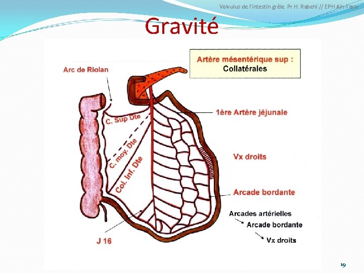 Volvulus de l’intestin grêle. Pr H. Rabehi // EPH Ain-Taya Gravité 19 