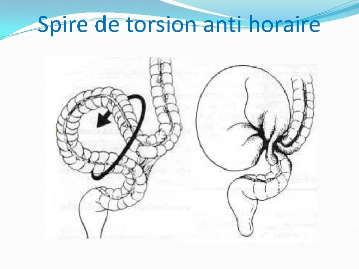 Spire de torsion anti horaire 