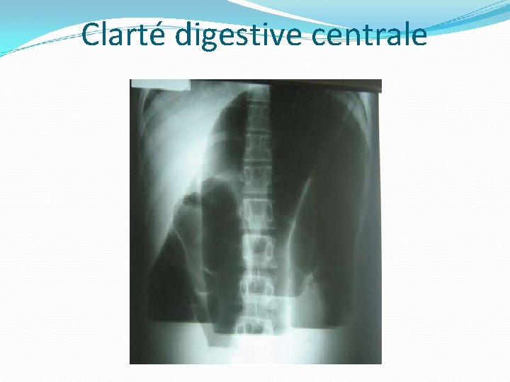 Clarté digestive centrale 