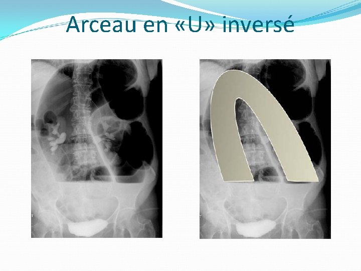 Arceau en «U» inversé 