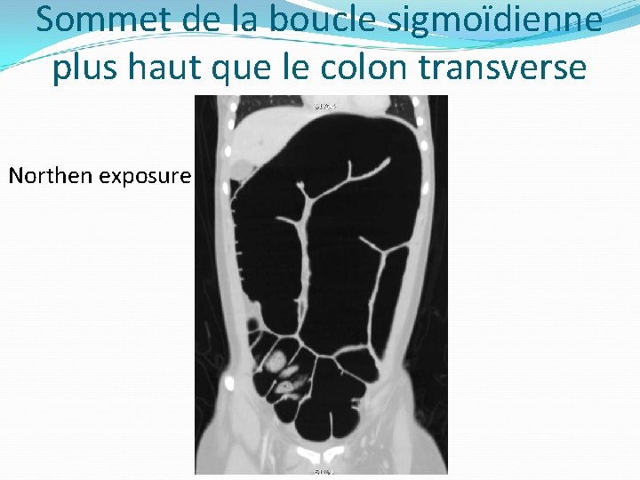 Sommet de la boucle sigmoïdienne plus haut que le colon transverse Northen exposure 