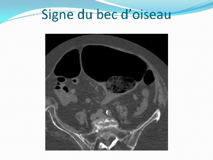 Signe du bec d’oiseau 