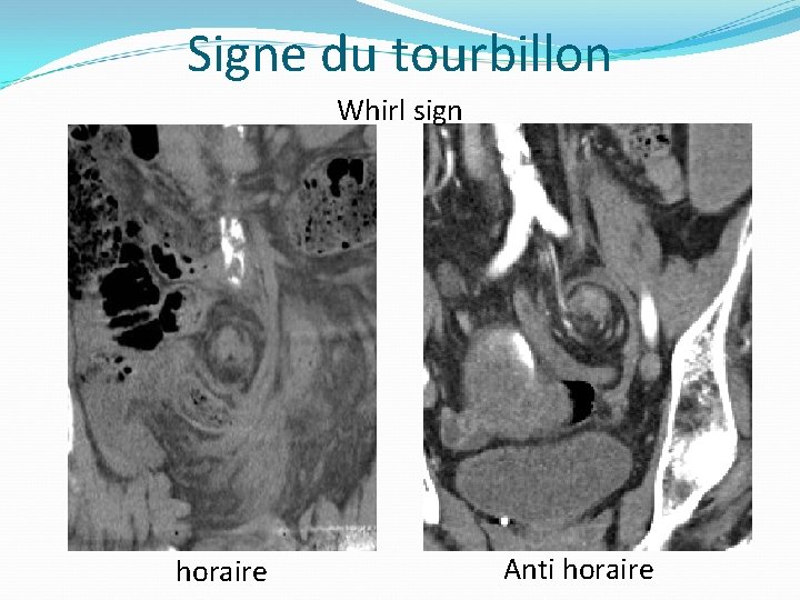 Signe du tourbillon Whirl sign horaire Anti horaire 