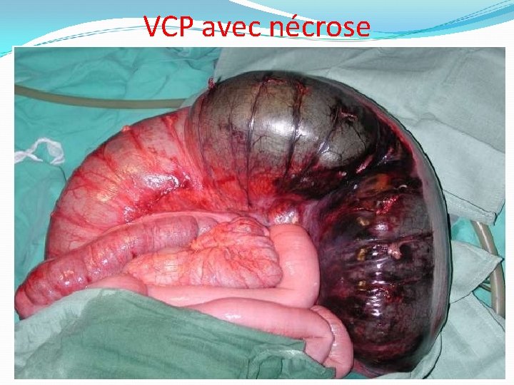 VCP avec nécrose 