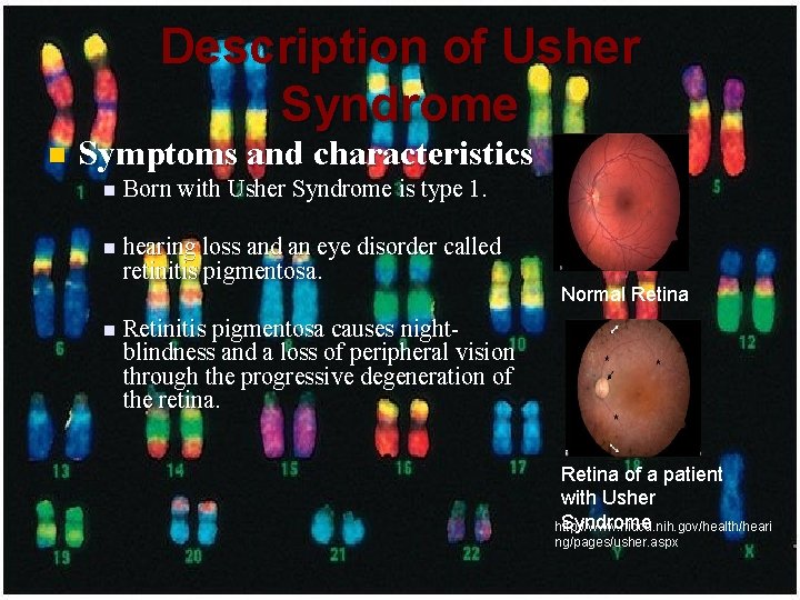 Description of Usher Syndrome n Symptoms and characteristics n Born with Usher Syndrome is