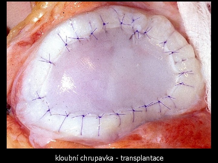 kloubní chrupavka - transplantace 