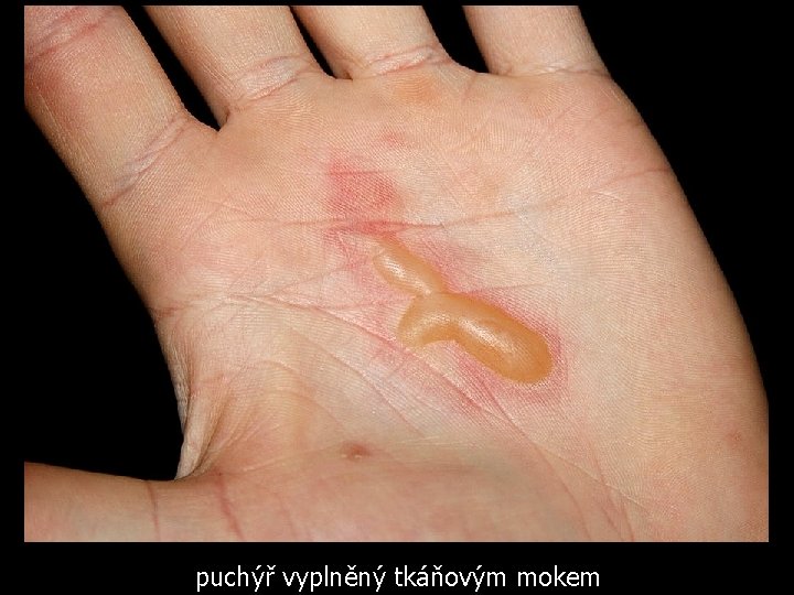 puchýř vyplněný tkáňovým mokem 