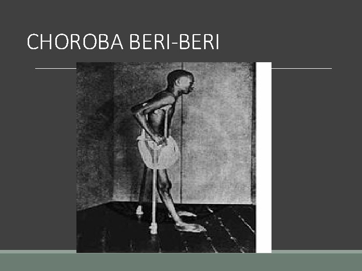 CHOROBA BERI-BERI 