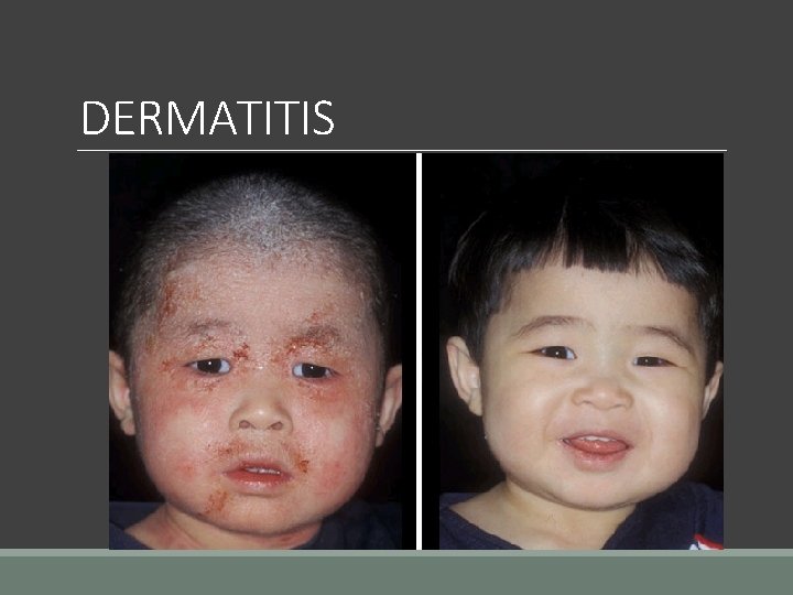 DERMATITIS 