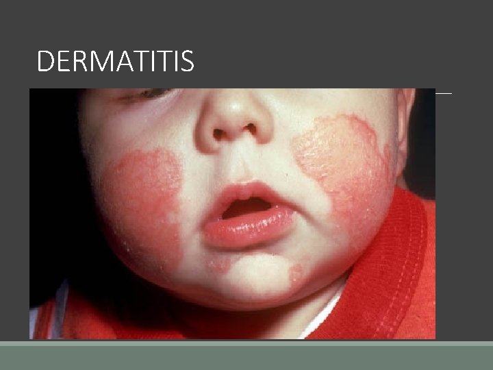 DERMATITIS 