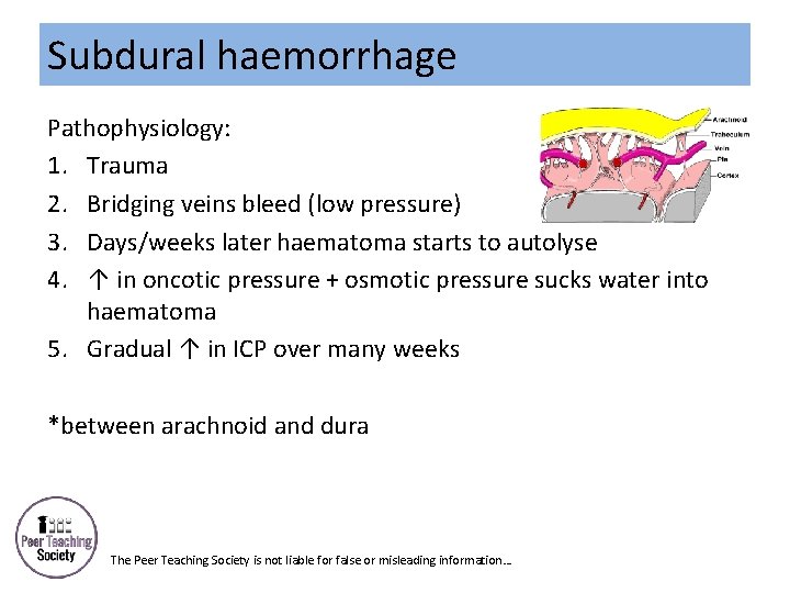 Subdural haemorrhage Pathophysiology: 1. Trauma 2. Bridging veins bleed (low pressure) 3. Days/weeks later