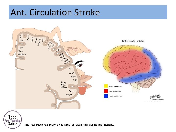 Ant. Circulation Stroke The Peer Teaching Society is not liable for false or misleading