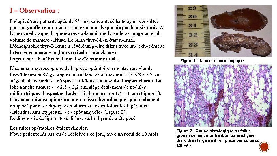 I – Observation : Il s’agit d’une patiente âgée de 55 ans, sans antécédents