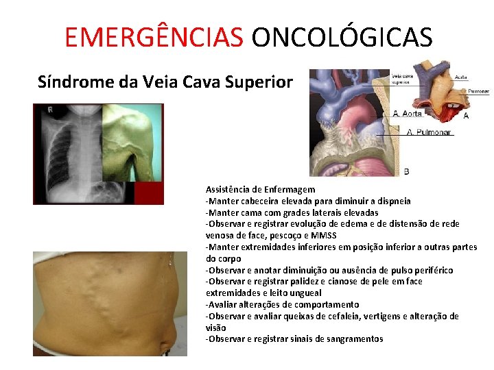 EMERGÊNCIAS ONCOLÓGICAS Síndrome da Veia Cava Superior Assistência de Enfermagem -Manter cabeceira elevada para