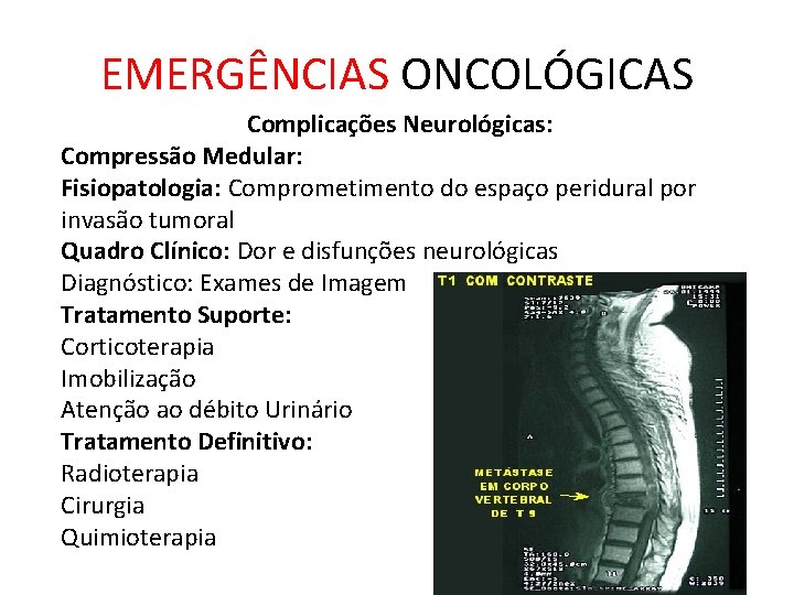 EMERGÊNCIAS ONCOLÓGICAS Complicações Neurológicas: Compressão Medular: Fisiopatologia: Comprometimento do espaço peridural por invasão tumoral