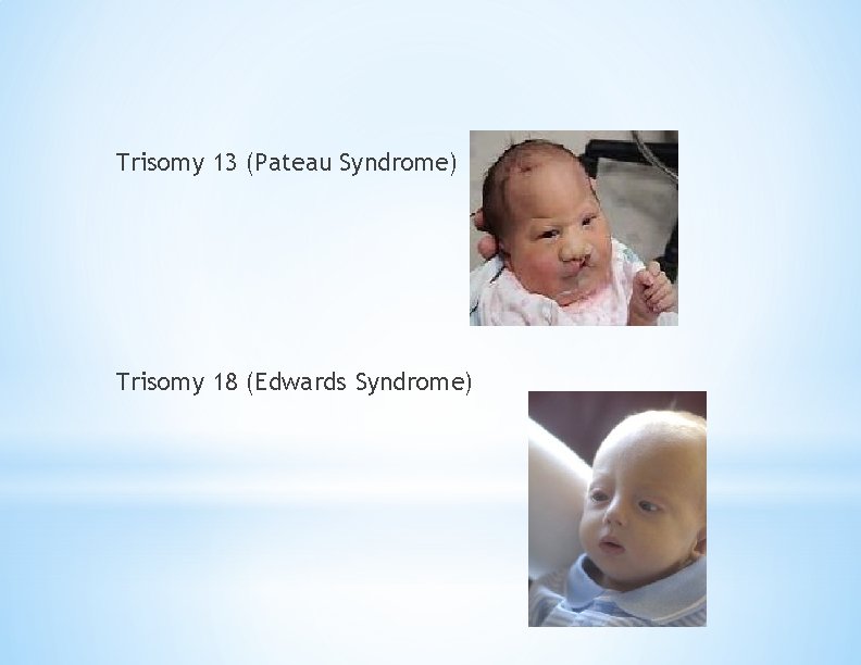 Trisomy 13 (Pateau Syndrome) Trisomy 18 (Edwards Syndrome) 