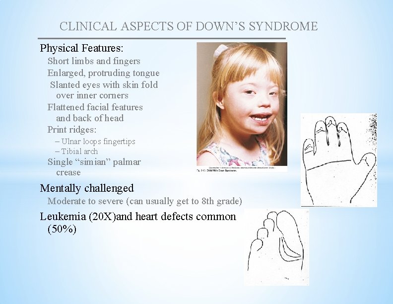 CLINICAL ASPECTS OF DOWN’S SYNDROME Physical Features: Short limbs and fingers Enlarged, protruding tongue