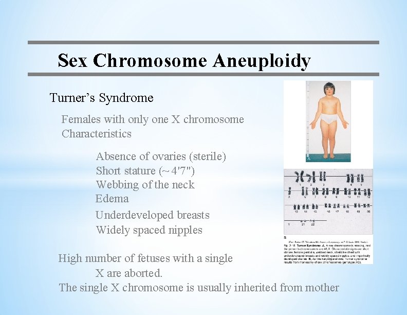 Sex Chromosome Aneuploidy Turner’s Syndrome Females with only one X chromosome Characteristics Absence of