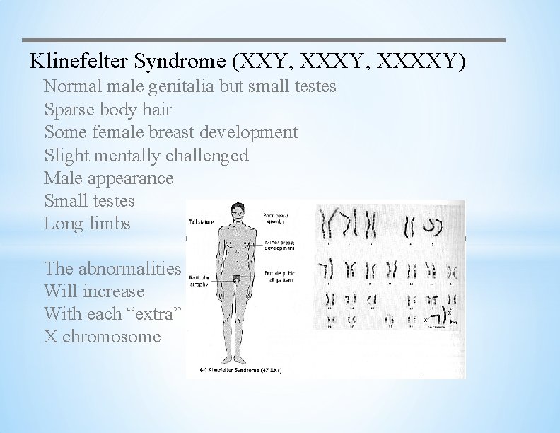 Klinefelter Syndrome (XXY, XXXXY) Normal male genitalia but small testes Sparse body hair Some