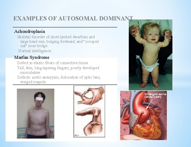 EXAMPLES OF AUTOSOMAL DOMINANT Achondroplasia Skeletal disorder of short-limbed dwarfism and large head size,