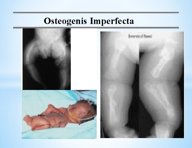 Osteogenis Imperfecta 