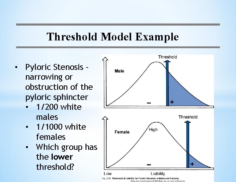 Threshold Model Example • Pyloric Stenosis – narrowing or obstruction of the pyloric sphincter