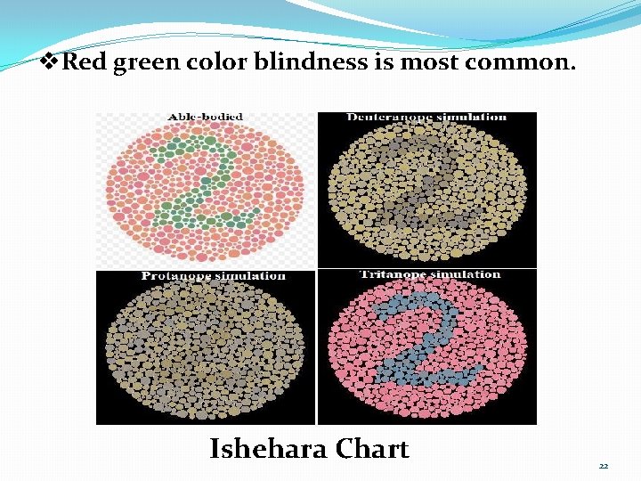 v. Red green color blindness is most common. Ishehara Chart 22 