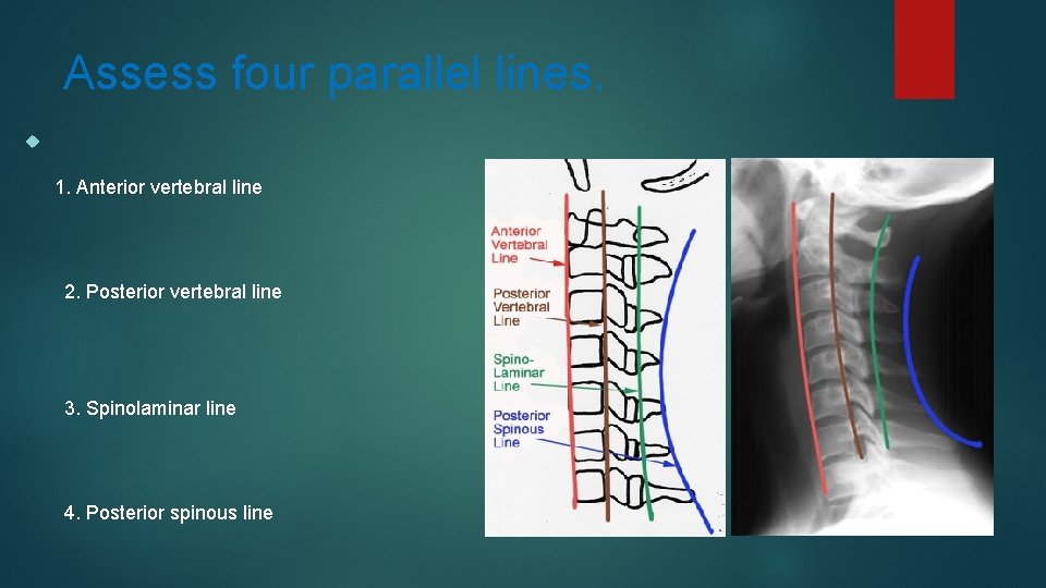 Assess four parallel lines. 1. Anterior vertebral line 2. Posterior vertebral line 3. Spinolaminar