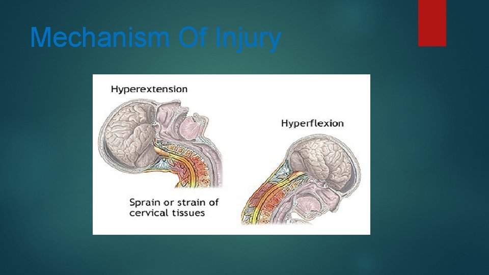 Mechanism Of Injury 