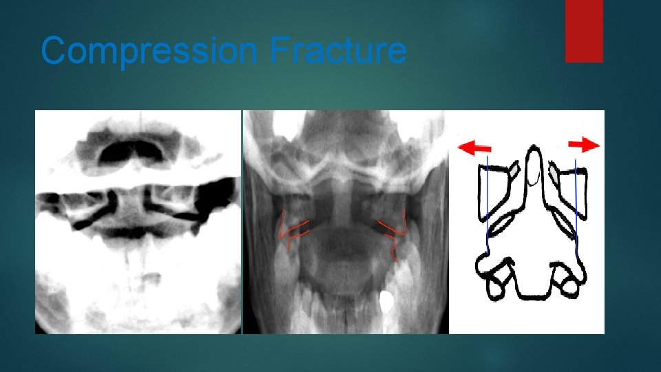 Compression Fracture 