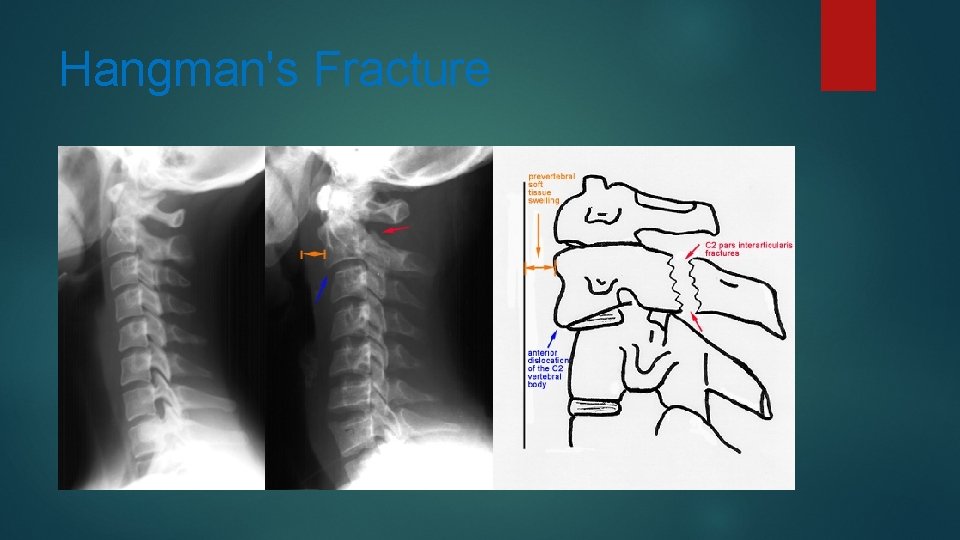 Hangman's Fracture 