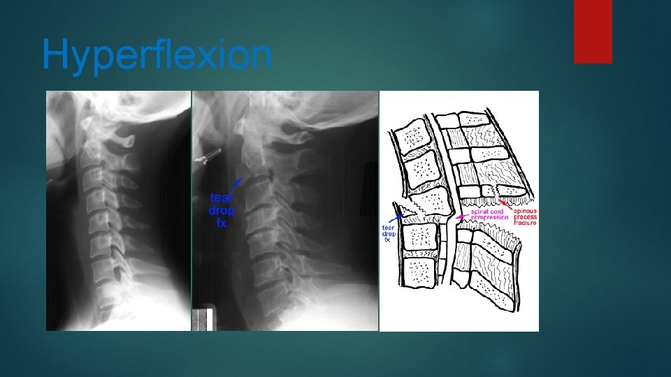 Hyperflexion 