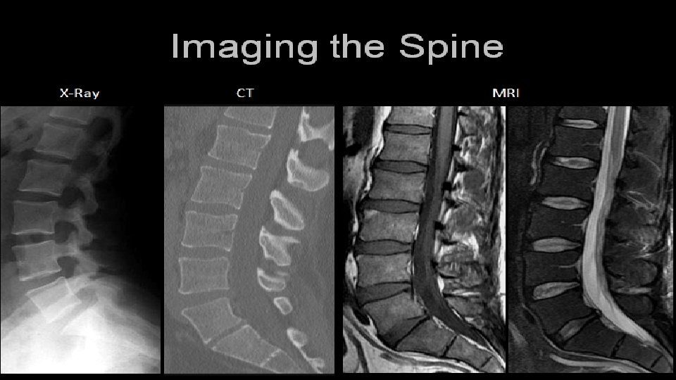Imaging Methods to Evaluate Spine 
