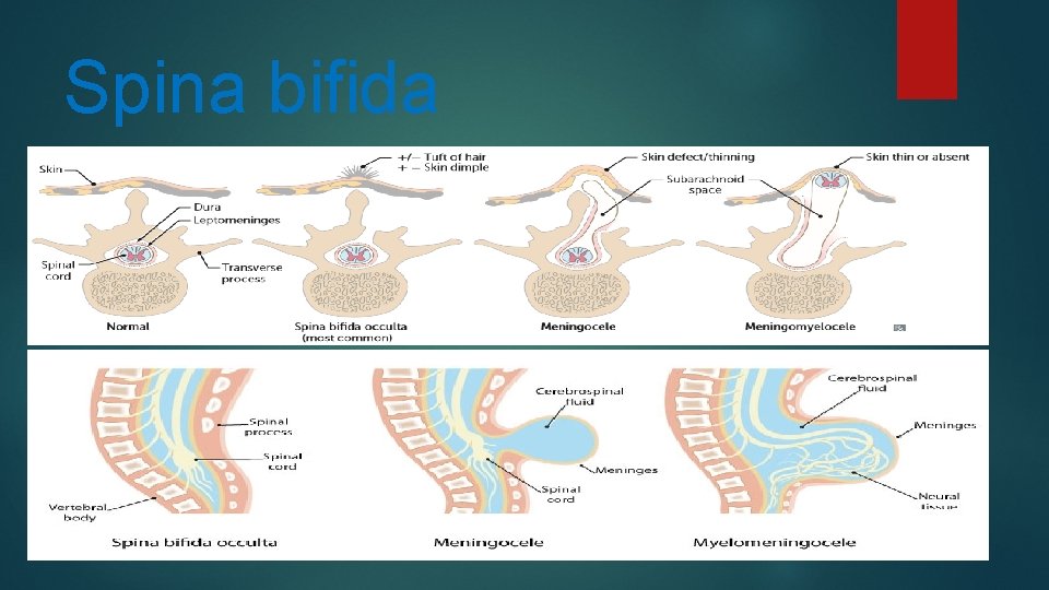 Spina bifida 