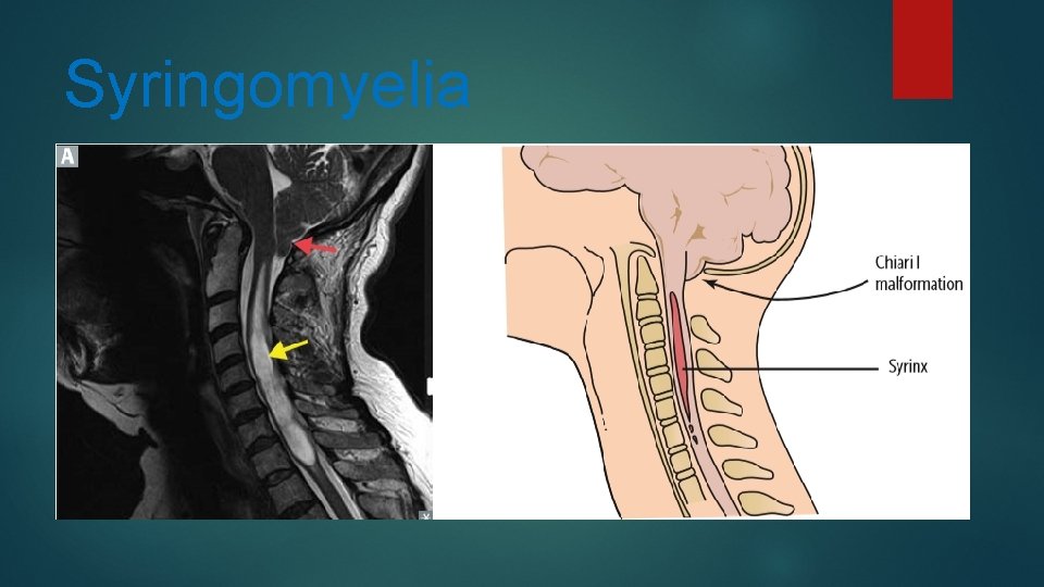 Syringomyelia 
