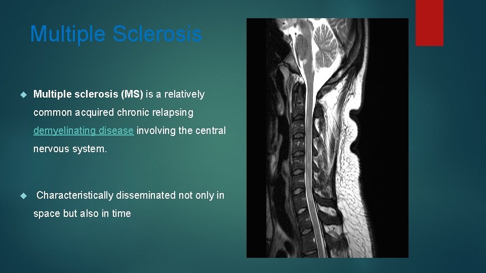 Multiple Sclerosis Multiple sclerosis (MS) is a relatively common acquired chronic relapsing demyelinating disease
