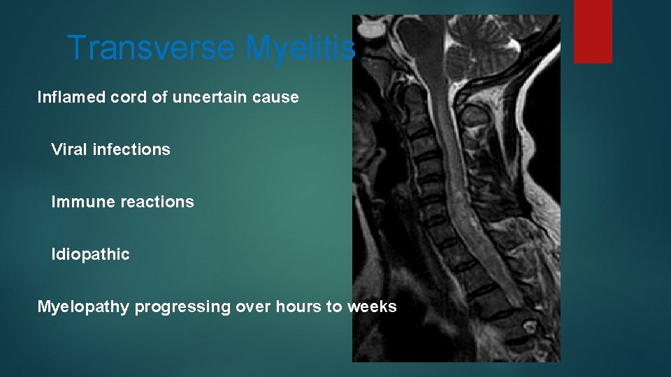 Transverse Myelitis Inflamed cord of uncertain cause Viral infections Immune reactions Idiopathic Myelopathy progressing