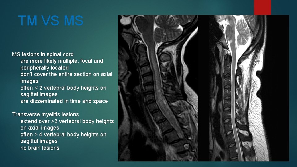 TM VS MS MS lesions in spinal cord are more likely multiple, focal and