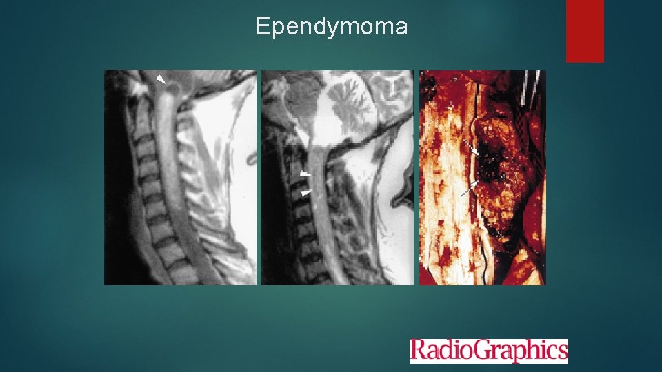 Ependymoma 