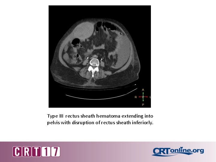 Type III rectus sheath hematoma extending into pelvis with disruption of rectus sheath inferiorly.