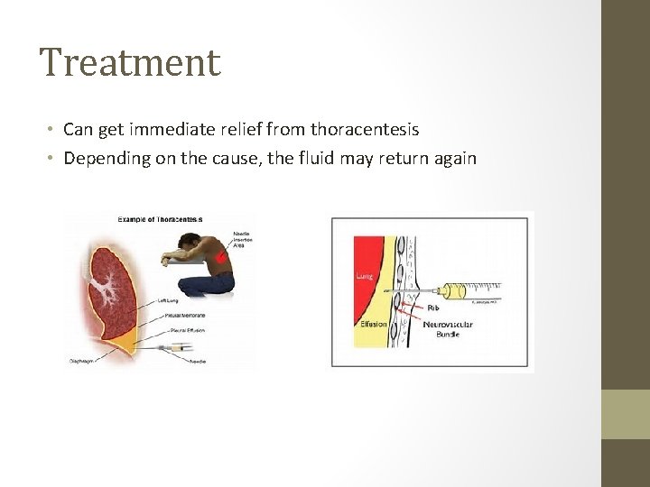 Treatment • Can get immediate relief from thoracentesis • Depending on the cause, the