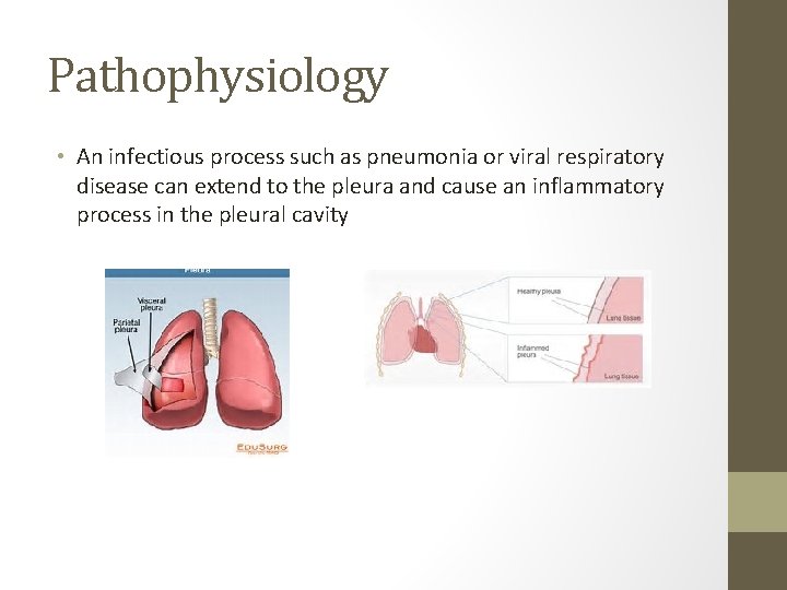 Pathophysiology • An infectious process such as pneumonia or viral respiratory disease can extend
