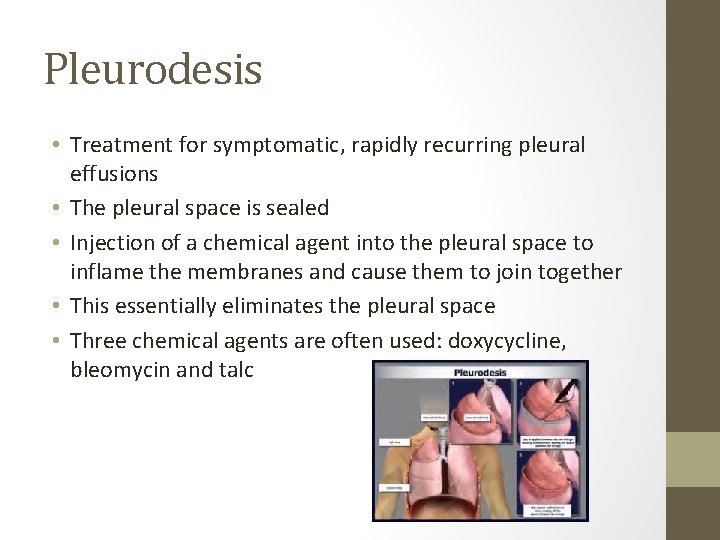 Pleurodesis • Treatment for symptomatic, rapidly recurring pleural effusions • The pleural space is