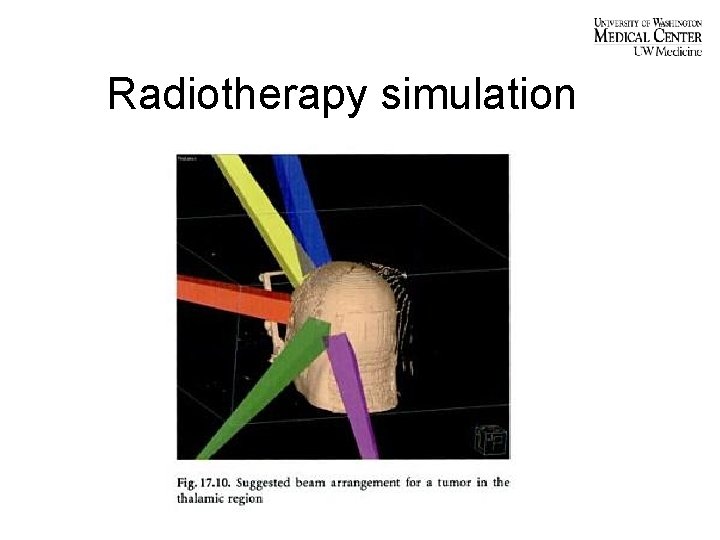 Radiotherapy simulation 
