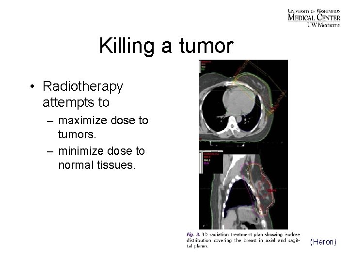 Killing a tumor • Radiotherapy attempts to – maximize dose to tumors. – minimize