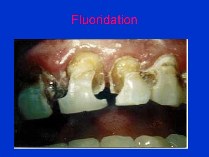 Fluoridation 