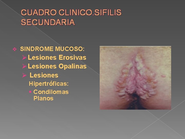 CUADRO CLINICO. SIFILIS SECUNDARIA v SINDROME MUCOSO: Ø Lesiones Erosivas Ø Lesiones Opalinas Ø