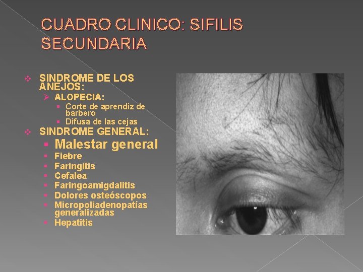 CUADRO CLINICO: SIFILIS SECUNDARIA v SINDROME DE LOS ANEJOS: Ø ALOPECIA: § Corte de